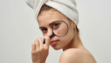 magnifying acne