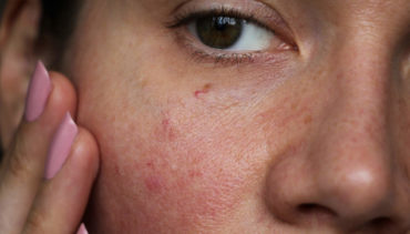 acne rosacea face