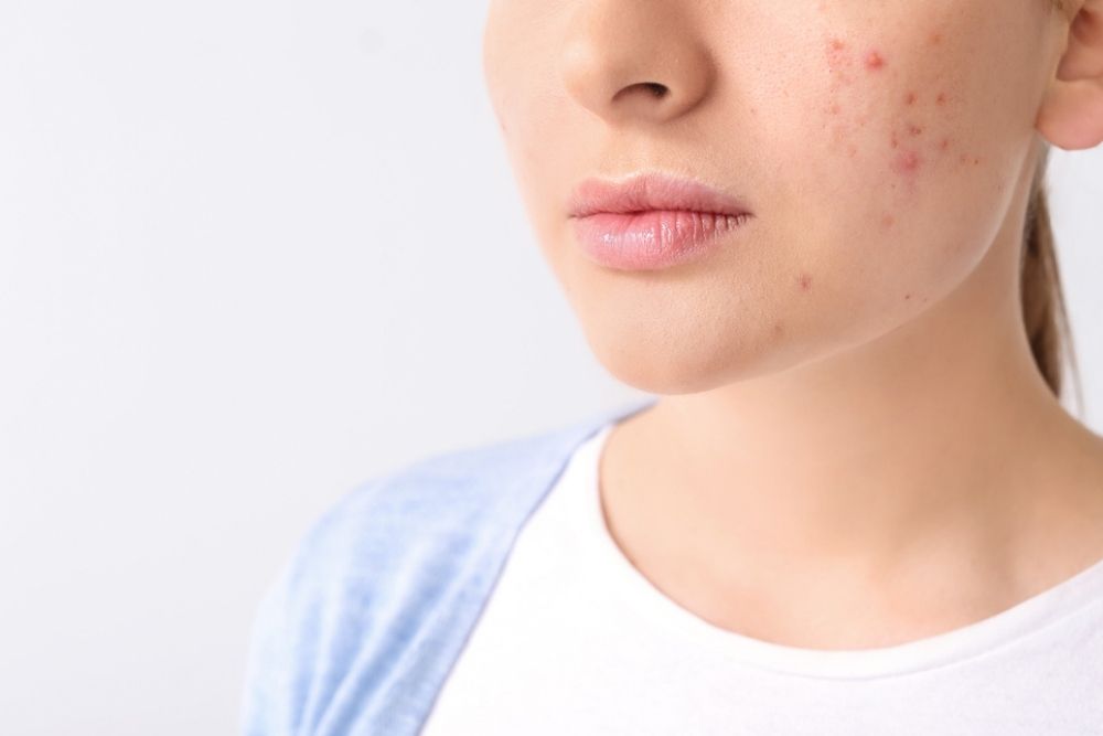 young woman with acne