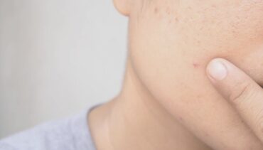 kid with pimple on his cheek