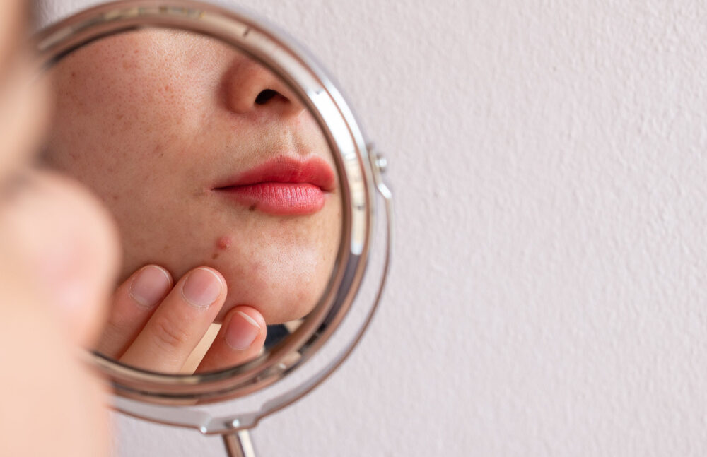 woman with pimples