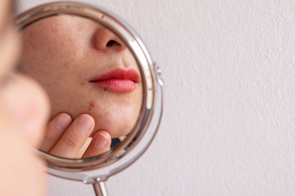 woman with pimples