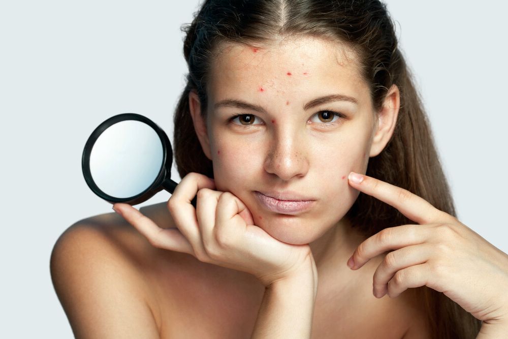 young woman with acne pointing her face