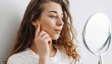 young woman with acne loooking her face in the mirror