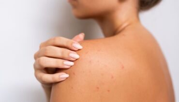 woman sun rash
