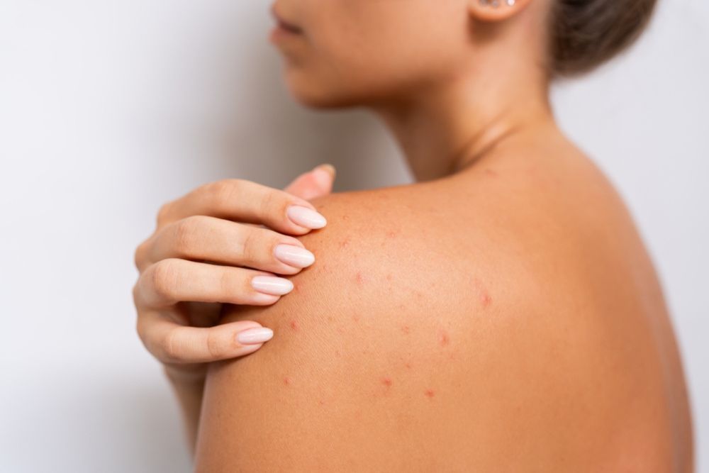 woman sun rash