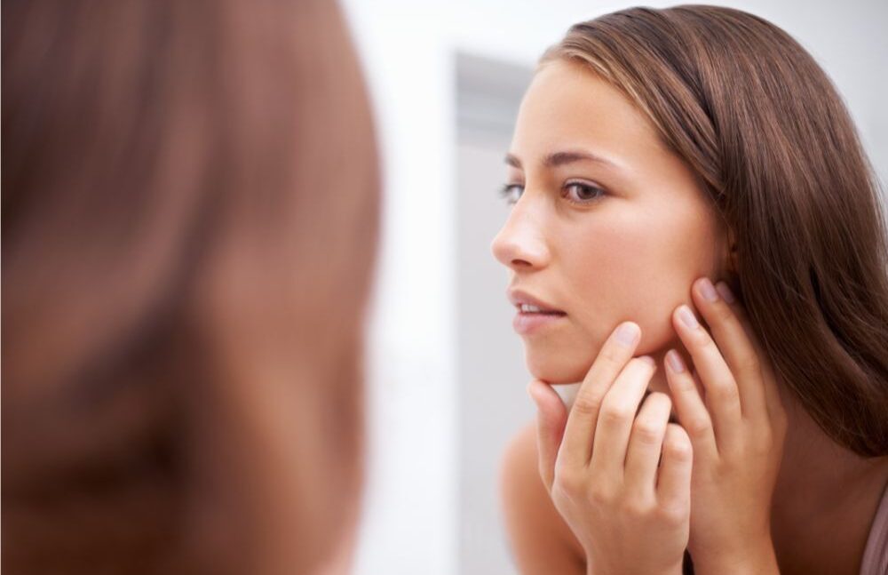 woman with acne