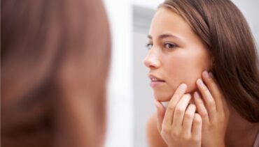 woman with acne